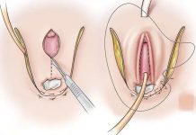4 Loại Phẫu Thuật Chuyển Giới Phổ Biến Nhất