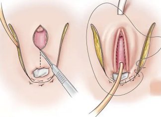4 Loại Phẫu Thuật Chuyển Giới Phổ Biến Nhất