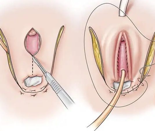 4 Loại Phẫu Thuật Chuyển Giới Phổ Biến Nhất