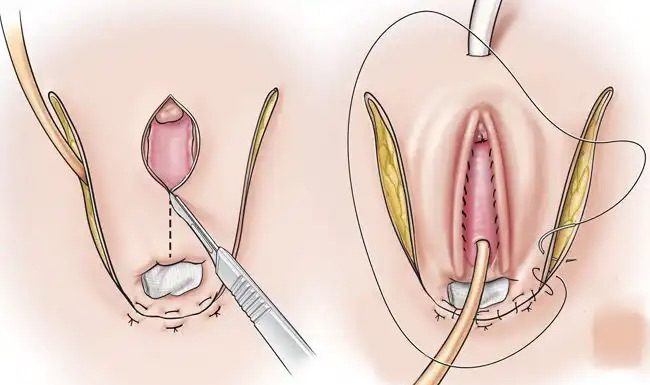 4 Loại Phẫu Thuật Chuyển Giới Phổ Biến Nhất